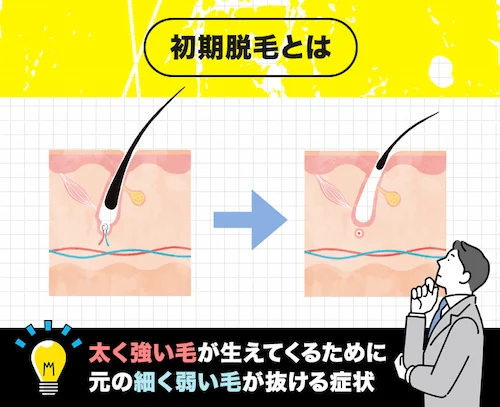初期脱毛について